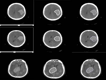 Hemorragia cerebral