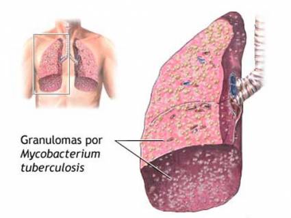 Tuberculosis