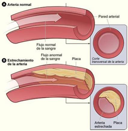 Arterias