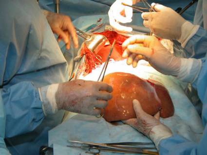 Programa nacional de trasplante de hígado en Cuba
