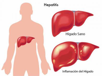 Hepatitis