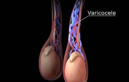 Varicocele