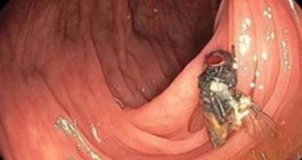 Un hombre fue a su consulta médica de rutina y encontraron una mosca viva en sus intestinos