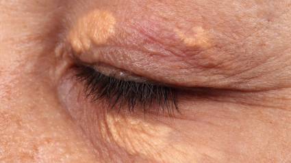 ¿Qué podrían decir las manchas alrededor de los ojos sobre tu salud?