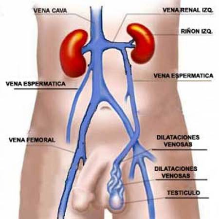 Varicocele