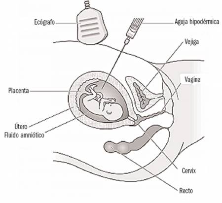 La amniocentesis