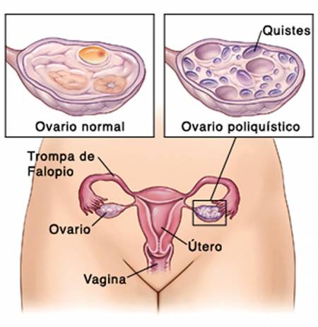 Acumulación de quistes en los ovarios