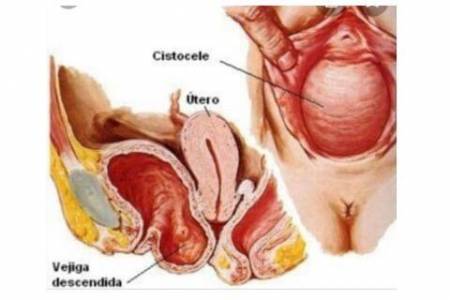 Descenso de la pared vaginal anterior por presión de la vejiga