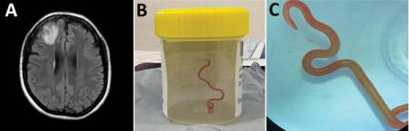 Un escáner cerebral y el nematodo extraído en un frasco de muestras. 
