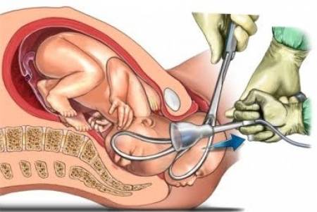 Forceps