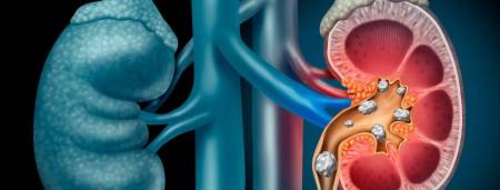 La litiasis renal