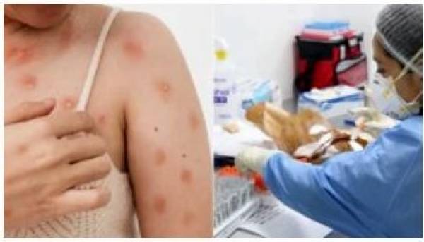 California, third US state to declare a monkeypox emergency – Juventud Rebelde